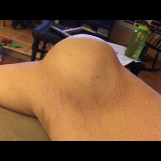 A swollen knee with visible bruising on a patient's leg is seen indoors, set against a background of tiled flooring and furniture, illustrating the intricacies of the case.