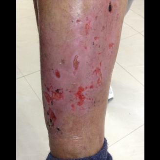 A close-up of a leg with red, irritated, and broken skin suggests a rash or infection, potentially linked to varicose vein insufficiency, on a light-colored floor.