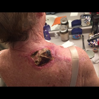 An elderly person's upper back shows a large, dark, and crusted wound near the shoulder, surrounded by red skin in a bathroom setting, indicating possible wound infection post melanoma resection.