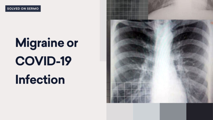 X-ray image of lungs with text: "Migraine or COVID-19 Infection" on a graphic background, featured in the May 2021 edition of Sermo.