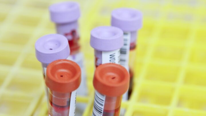 A close-up of blood samples in test tubes, capped in purple and orange, neatly arranged in a yellow rack—providing reliable serological data for physicians to analyze.