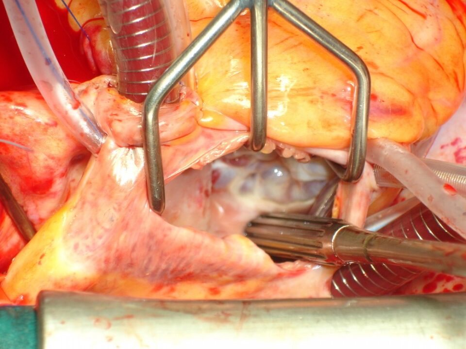 Open-heart surgery in progress, showing exposed heart with surgical tools and tubes.