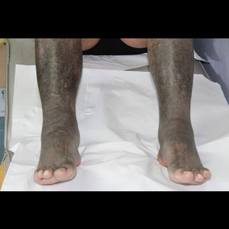 A person's legs and feet, tinged with a bluish hue, are shown with visibly thickened and darkened skin. The person is seated on a white paper-covered surface.