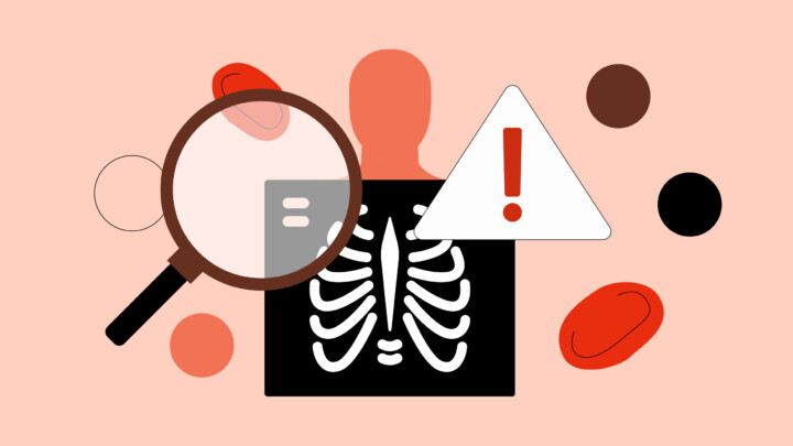 Illustration of a human silhouette behind a magnifying glass, X-ray of ribs, warning sign with exclamation point, and scattered red and brown blood cells—symbolizing the importance of prior authorization in medical procedures.