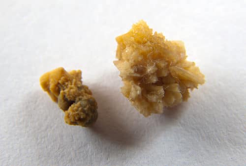 Close-up of two kidney stones resembling unique medical souvenirs; one is small and rough, while the other is larger with a jagged, crystalline appearance, set against a plain white background.