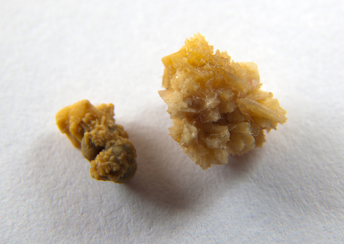 Close-up of two kidney stones resembling unique medical souvenirs; one is small and rough, while the other is larger with a jagged, crystalline appearance, set against a plain white background.