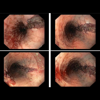 Endoscopic images reveal sections of the gastrointestinal tract with signs of inflammation and potential lesions, possibly indicating incomplete Boerhaave-Syndrome.