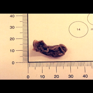 A small, irregularly shaped brown object, reminiscent of a specimen related to Thoracic Endometriosis Syndrome, is placed near a ruler for scale, displaying measurements in both centimeters and inches.