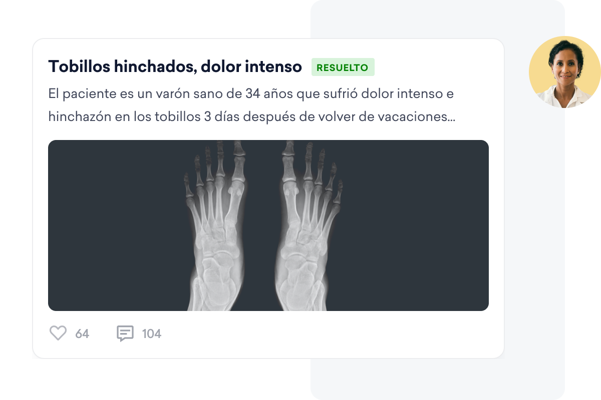 En un caso médico publicado en una página social para médicos se muestra una imagen de rayos X de dos pies, que detalla a un hombre de 34 años con tobillos hinchados y dolor severo.