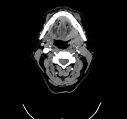 CT scan image showcasing a transverse section of the neck area, highlighting various anatomical structures and tissues in grayscale as part of the patient case analysis.