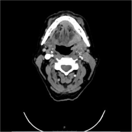 CT scan image showcasing a transverse section of the neck area, highlighting various anatomical structures and tissues in grayscale as part of the patient case analysis.