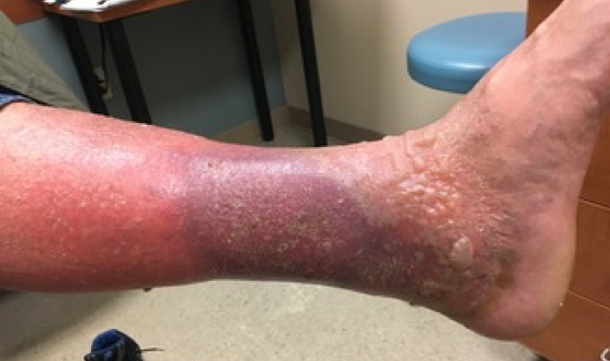 Close-up of an ankle showing redness, swelling, and scaling skin, likely indicating a medical condition. The setting appears to be a doctor's office with furniture and a shoe visible.