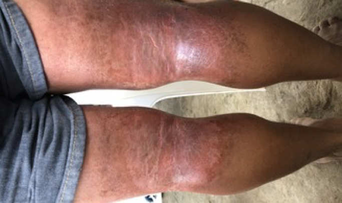 A person's legs, showing a popliteal rash with visible skin irritation and redness, are pictured while they're sitting on a chair wearing shorts.