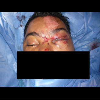 A person with facial injuries and stitches, likely from a car crash, lies on a blue surgical drape with eyes closed, their mouth obscured.